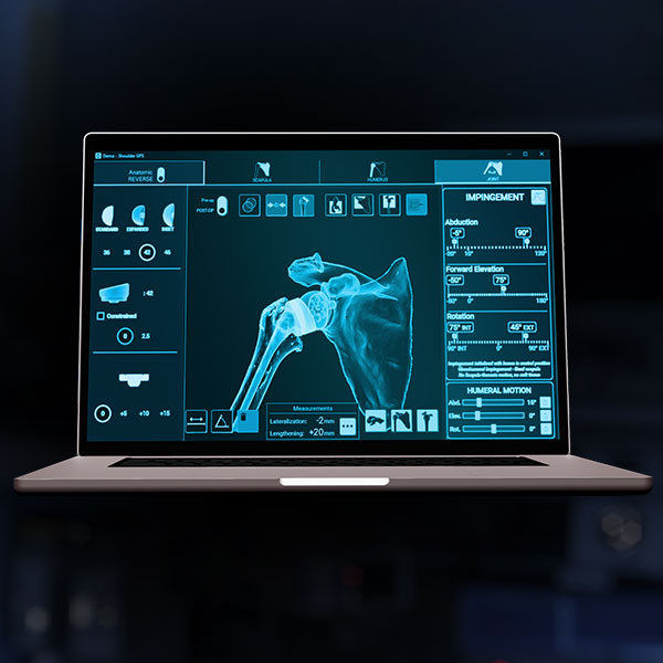 Exactech Equinoxe Planning App
